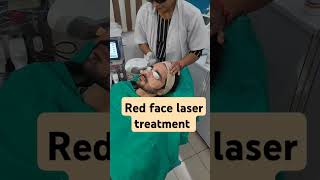 IPL treatment for Red face Rossesea treatments [upl. by Khosrow693]