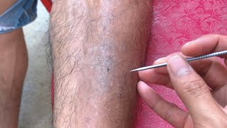 Find Pluck ingrown hairs for mr phú đầu bò ASMR [upl. by Hausmann]