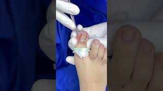 Matricectomia química ingrowntoenailsurgery podologo satisfying [upl. by Pia]