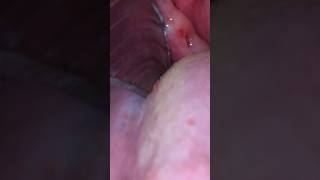 Tonsil stone removal gone horribly bad [upl. by Suirada156]