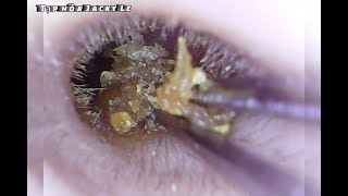 Ear Wax Removal 37  Clean Wet Earwax  Ear Cleaning ASMR [upl. by Paloma486]