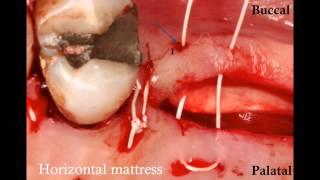 How to suture a large flap a SurgicalMaster Instant Replay [upl. by Hum]