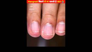 Why you shouldnt peel your Hangnail 😱 shorts [upl. by Assirahc]