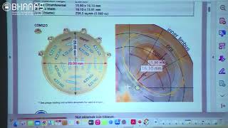 Plaque brachytherapy for intraocular tumors [upl. by Euginom662]