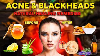 Natural Remedies For Clear Skin Get Rid of Acne and Blackheads [upl. by Ativel]