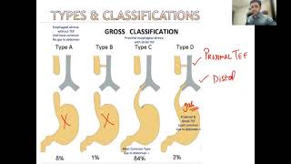 Tracheoesophageal Fistula By DrAnand  Nelson Updates [upl. by Adlecirg]