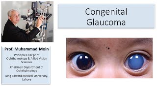 Eye Lectures Congenital Glaucomas [upl. by Quirk339]