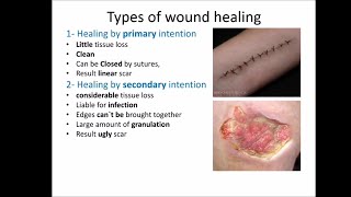 wound healing [upl. by Charmian44]