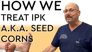 How We Treat IPK  Porokeratosis  Seed Corns [upl. by Ari918]