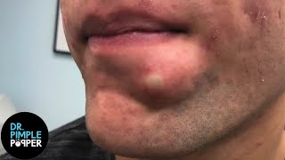 SATISFYING Dr Lee Pops Inflamed Cyst on Chin  Dr Pimple Popper Reacts [upl. by Eppilihp]