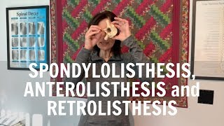 Spondylolisthesis anterolisthesis and retrolisthesis explained by Irvine Chiropractor [upl. by Alveta]