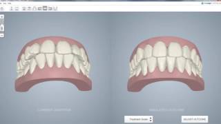 Invisalign Scanner  Itero  Bubon Orthodontics [upl. by Aljan918]