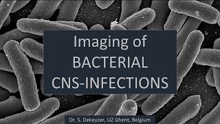 Imaging of bacterial pyogenic brain infections [upl. by Alburg362]