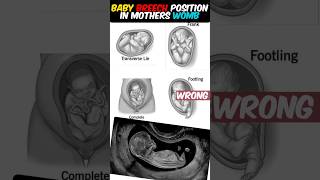 Baby WRONG breech position in MOTHERS womb ultrasound pregnant shorts 🤰 [upl. by Colb]