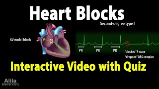 Heart AV Blocks  INTERACTIVE Animation with Quiz [upl. by Murtagh]