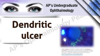 Dendritic ulcer  APS Undergraduate Ophthalmology [upl. by Cohe454]