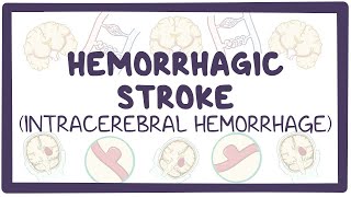 Hemorrhagic stroke intracerebral hemorrhage  causes symptoms diagnosis treatment pathology [upl. by Notnirt]