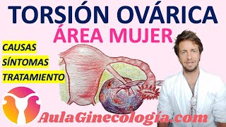 TORSIÓN OVÁRICA CAUSAS SÍNTOMAS TRATAMIENTO  Ginecología y Obstetricia [upl. by Xella]