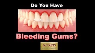 Bleeding Gum what you should know [upl. by Kerrie]