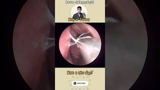 콧물제거영상 nose satisfyingvideo sinusitis rhinitis cleaning asmr [upl. by Einittirb477]