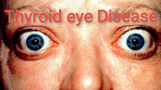 Orbit  Thyroid Eye Disease Graves ophthalmopathy  Part 4 [upl. by Nollie]