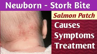 Newborn Stork Bite Salmon Patch Causes Symptoms Diagnosis amp Treatment [upl. by Adnohsal]