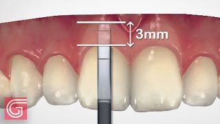 HOW TO Use Dental Bone Sounding Gauge BEFORE Gingivectomy [upl. by Beker]