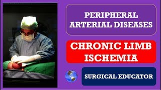 CHRONIC LOWER LIMB ISCHEMIA  How To DIAGNOSE amp TREAT Peripheral Arterial Diseases [upl. by Ferreby276]