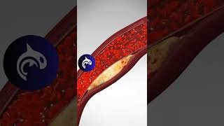 See what a Blood Clot looks like in your arteries  artery bloodclot heart [upl. by Eecyaj]