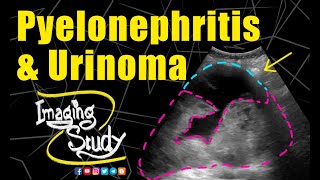 Pyelonephritis with Urinoma  Ultrasound  Case 234 [upl. by Sairacaz]