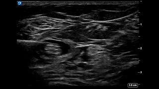 UltrasoundGuided Popliteal Sciatic Nerve Block  Singel handed user [upl. by Jordans]