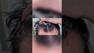 Finasteride results finasteride hairlosstreatment hair hairlosscure hairloss [upl. by Bondon]