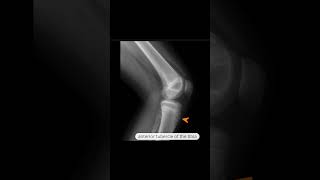 OsgoodSchlatter disease [upl. by Karisa51]