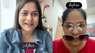 Cholesterol deposit surgery me kitna paisa laga  Xanthelasma Removal Surgery Before amp After [upl. by Acinorav]