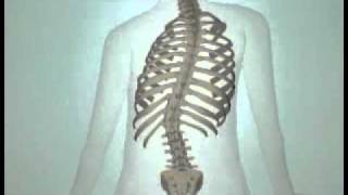 Teen Scoliosis Causes and Treatment Options DePuy Videos [upl. by Ajay]