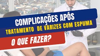 Tratamento de Varizes com Espuma o que pode acontecer após a escleroterapia e o que fazer [upl. by Eidolem]