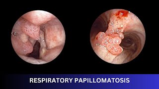 RESPIRATORY PAPILLOMATOSIS  Bronchoscopic Management [upl. by Ahsille]