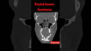 Facial Bones Fractures  CT Face shorts shortsfeed radiology ctface fracture [upl. by Garaway175]