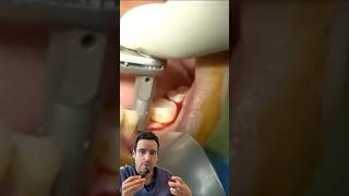 Cas Clinique  Pose IMPLANT DENTAIRE live [upl. by Livingstone]