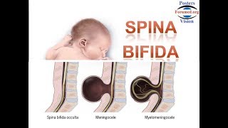 Spina Bifida les Causes et la Prévention par acide folique vitamine B9 [upl. by Trbor]