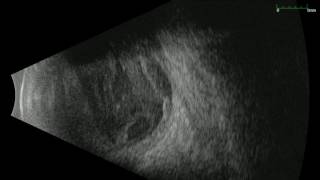 Ophthalmic Edge  Typical Endophthalmitis Case Seen by Ultrasound [upl. by Trisa]