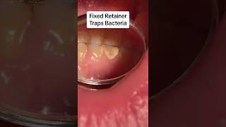 Retainers keep teeth together Removable retainers vs fixed retainer cosmeticdentistry retainers [upl. by Azmah]