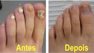 NÃO use muito Esta é a melhor solução para acabar com fungos nas unhas [upl. by Etnauj]