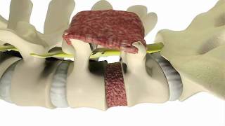 Back Pain Relief with Minimally Invasive TLIF procedure  DePuy Videos [upl. by Worsham]