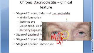 Ophthalmology 402 a Chronic DaCryoCystitis catarrhal mucocele suppurative fibrotic [upl. by Zinnes]