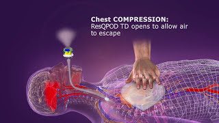 ResQPOD ITD Overview [upl. by Arraeit353]