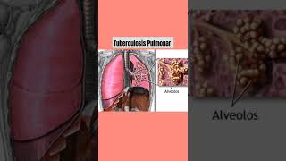 Tuberculosis Pulmonar medicina [upl. by Ringe]