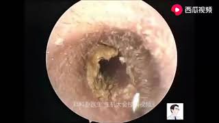 Cleaning Up Cerumen Massive Ear Wax Removal Extractions of Dry Earwax from Entire Ear Canal 340 [upl. by Pattin201]