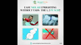 Easy Lower 2nd Molar Uprighting WITHOUT TADS [upl. by Kirshbaum]