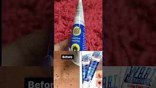 What is the most effective wart removal  Does wart removal really work  Honest Review [upl. by Feld]